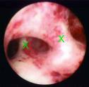 Hysteroscopic view of intrauterine adhesions and scar tissue in Asherman's syndrome