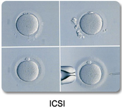 Intracytoplasmic Sperm Injection