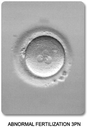 Abnormal 3PN Fertilization