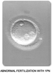 Abnormal Multi-PN Fertilization