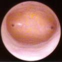 Hysteroscopic view of a normal, smooth endometrial uterine cavity